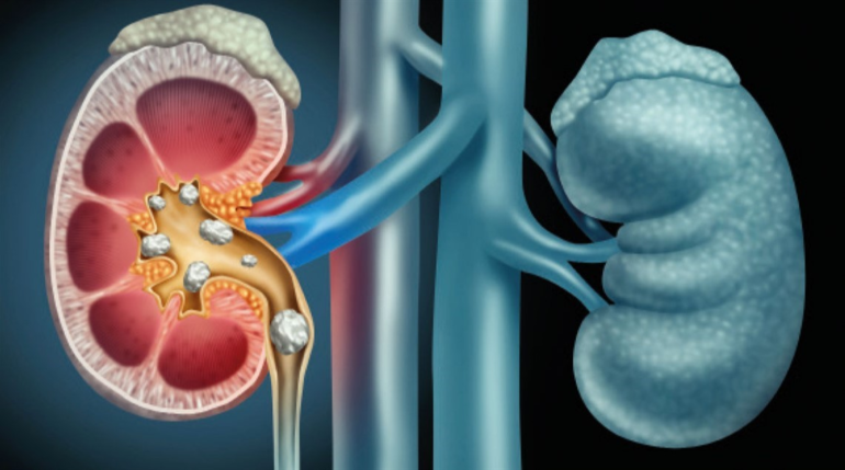 Enfermedad renal crónica (erc)